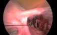 Ligature des artères utérines avant myomectomie cœlioscopique