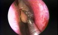 Polypectomie nasale par endoscopie