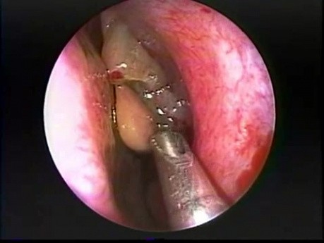 Polypectomie nasale par endoscopie