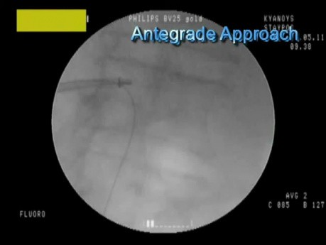 Urétérolithotripsie antégrade