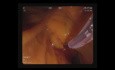 Duodénotomie et CPRE-Stent Biliare
