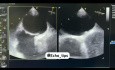 Tunnel de FOP (Foramen oval perméable) chez un Patient de 40 ans présenté avec CVS