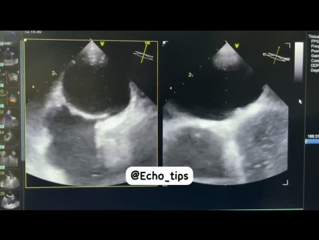 Tunnel de FOP (Foramen oval perméable) chez un Patient de 40 ans présenté avec CVS