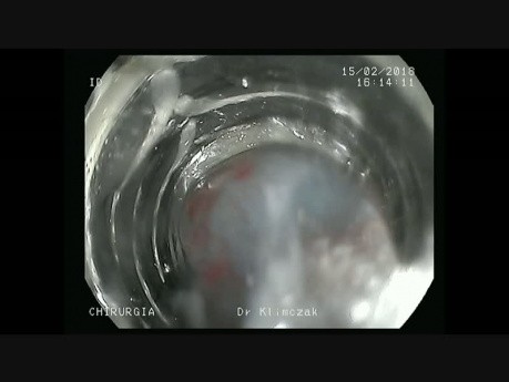 La chirurgie mini-invasive endoscopique des tumeurs neuroendocrines gastriques