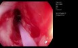 Dilatation endoscopique au ballonnet de l'oesophage pour une sténose caustique - deuxième séance