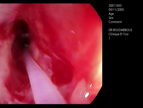 Dilatation endoscopique au ballonnet de l'oesophage pour une sténose caustique - deuxième séance