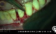Thérapie microchirurgicale au laser en parodontologie