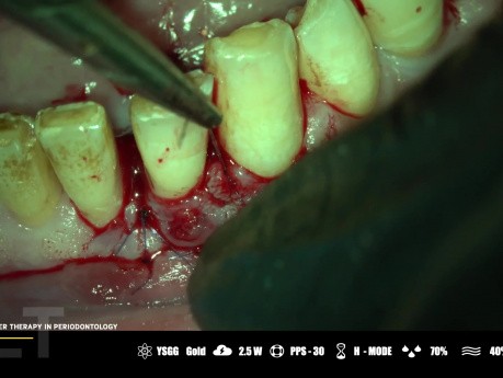 Thérapie microchirurgicale au laser en parodontologie