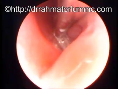 Extraction Ambulatoire de Corps Etranger Intra-Nasal
