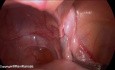Testicules non descendus non palpables - des cas de la prise en charge laparoscopique