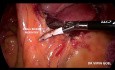 L'hémicolectomie droite radicale par voie laparoscopique avec exérèse totale du mésocôlon (ETMc)