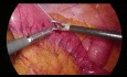 Jéjunostomie par voie laparoscopique