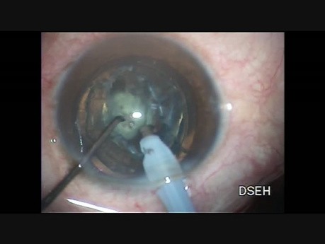 Rhexis ovale dans un cas de cataracte polaire postérieure avec rente préexistante