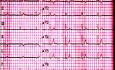 Quiz d'ECG n° 1. Un cas d'électrocardiographie. Un patient souffrant de faiblesse et de vertiges