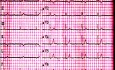 Quiz d'ECG n° 1. Un cas d'électrocardiographie. Un patient souffrant de faiblesse et de vertiges