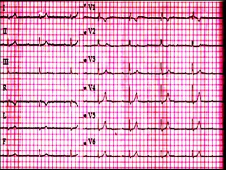 Quiz d'ECG n° 1. Un cas d'électrocardiographie. Un patient souffrant de faiblesse et de vertiges