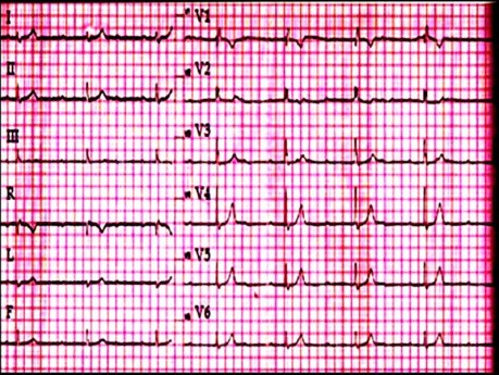 Quiz d'ECG n° 1. Un cas d'électrocardiographie. Un patient souffrant de faiblesse et de vertiges