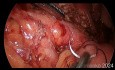 Pancréatojéjunostomie Longitudinale Laparoscopique