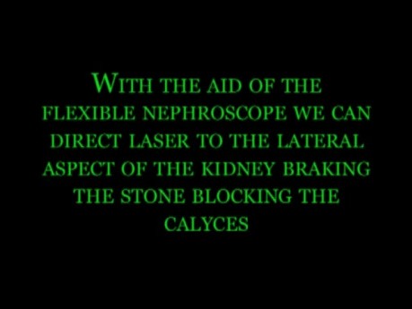 Néphrolithotomie percutanée - Cystinurie