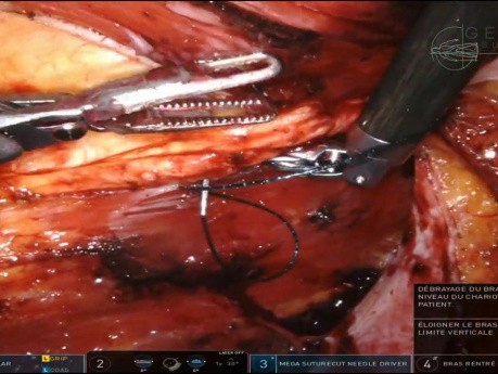 R-eTEP Diastasis Recti Latérale & UH, Inan, Plicature Inversée