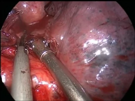Lobectomie en manchon du lobe moyen, chirurgie thoracique vidéo-assistée (CTVA)