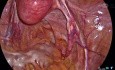 Hystérectomie Laparoscopique Totale - Dissection Rétropéritonéale Expliquée par le Dr Kunal Rathod