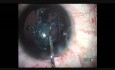 Capsulotomie à lame plasma dans la cataracte subluxée