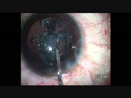 Capsulotomie à lame plasma dans la cataracte subluxée
