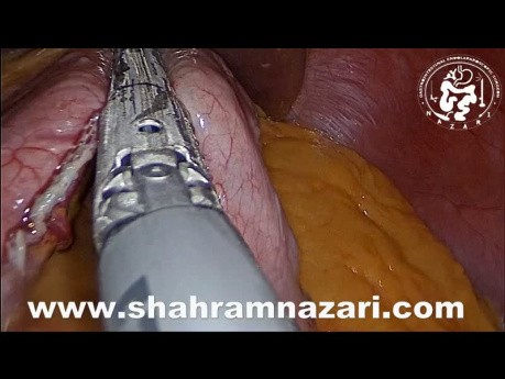 Renforcement à l'aide de sutures sur la ligne d'agrafes de sleeve gastrectomie