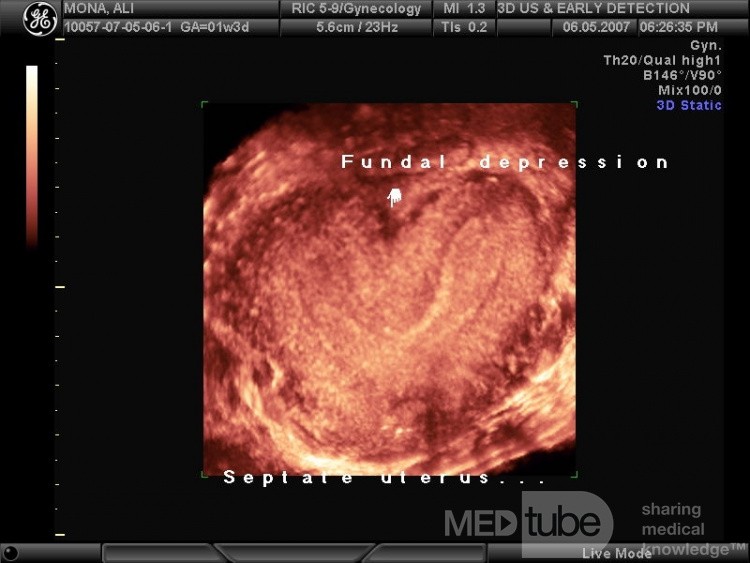 Utérus bicorne à l'échographie tridimensionnelle.