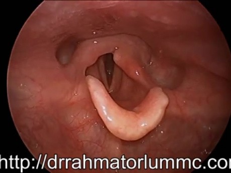 La Paralysie des Cordes Vocales Entièrement Compensée (Vidéo HD)