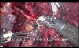 Lobectomie robotique pour tumeur carcinoïde obstruant la bronche basale du lobe inférieur droit