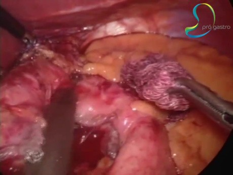 Pontage Gastrique Laparoscopique Après Fundoplicature de Nissen pour Reflux Gastro-œsophagien