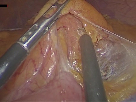 Résection Antérieure Basse par Laparoscopie pour le Traitement du Haut Rectum