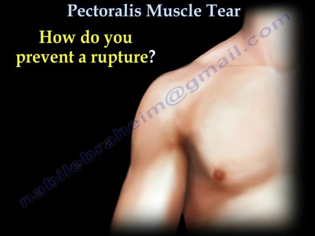 Muscle pectoral - déchirure du tendon