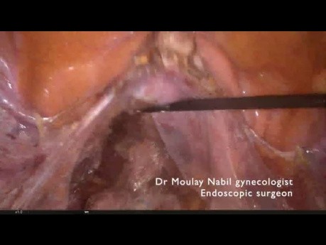 Sacrocolpopexie Standard pour Prolapsus Urogénital