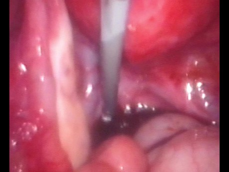 Cystectomie pour Endométriose Utilisant une Sonde de Foley