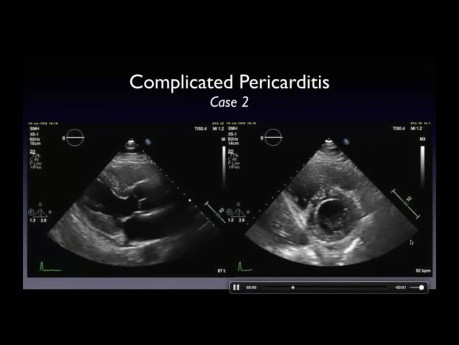 Péricardite Compliquée - Définition et Détection d'un Péricarde Pathologique.