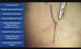 Nœud fait à l'aide des instruments - les techniques de la suture 