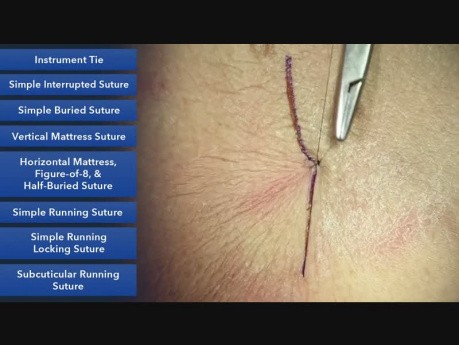 Nœud fait à l'aide des instruments - les techniques de la suture 
