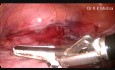 Hystérectomie laparoscopique totale