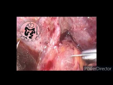 Exploration laparoscopique du CBD et anastomose après un échec de la CPRE