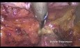 Hystérectomie radicale laparoscopique de type C1