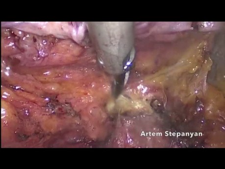 Hystérectomie radicale laparoscopique de type C1