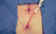 Colocación suprapúbica del cath durante una prostatectomía radical robótica