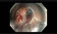 Coloscopie - Rectum - Tumeur à Extension Latérale Granulaire - EMR partie III