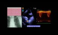 Coarctation de l'aorte - cas clinique: discussion sur l'ECG, l'échocardiogramme et le traitement