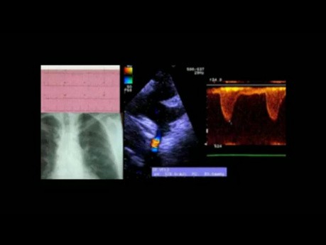 Coarctation de l'aorte - cas clinique: discussion sur l'ECG, l'échocardiogramme et le traitement