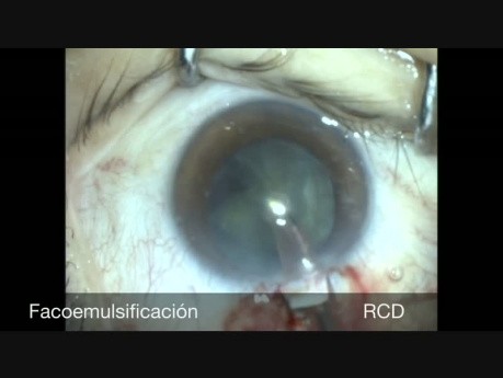 Phacotrabéculectomie à un port chez un patient atteint de kératotomie radiale et de glaucome