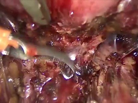 Nodule recto-vaginal